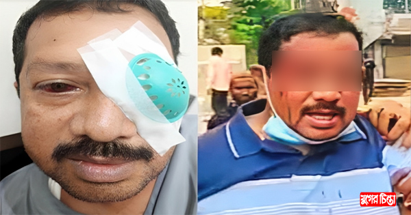 টিটুর দুই চোখে গুলিবিদ্ধ হওয়ার বিষয়টি আন্তর্জাতিক মহলের নজরে