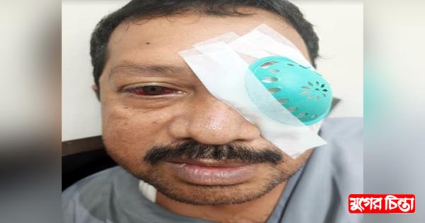 বাম চোখ নিয়ে শঙ্কায় ফতুল্লা&nbsp;থানা বিএনপির সভাপতি