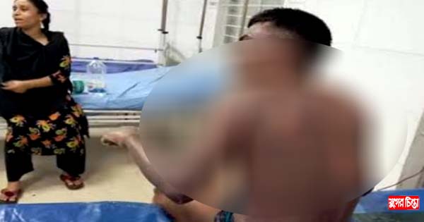 বিস্ফোরণে দ্বগ্ধ যুবক হাসপাতালে মৃত্যুর সঙ্গে পাঞ্জা লড়ছে