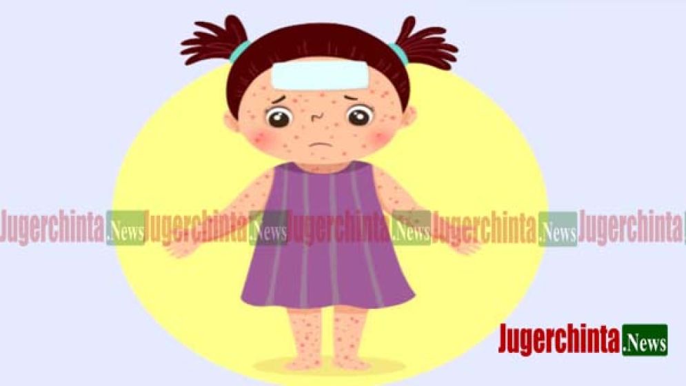 না.গঞ্জে বাড়ছে হামের সংক্রমণ, জনমনে উদ্বেগ